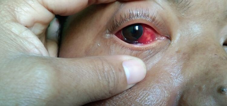 Eye Infections ( Conjuctivitis or Pink Eye)