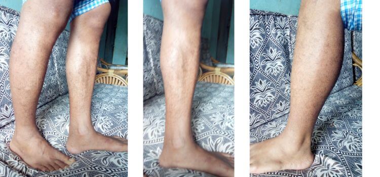 Living With Kidney Failure leg swelling 